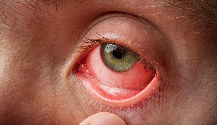 how long pink eye is contagious
